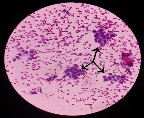 סרטן שד דלקתי - INFLAMMATORY CARCINOMA - מרכז רפואי זיו